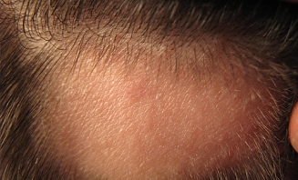 Alopecie 1
