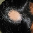 Alopecie 2