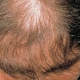 Alopecie 3
