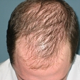 Alopecie 4