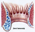 Hemoroidy (hemeroidy) 2