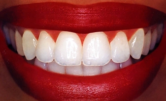 Bělení zubů 1