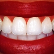 Bělení zubů 4