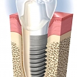 Zubní implantáty 2