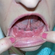 Zubní implantáty 3