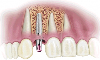 Zubní implantáty 1