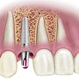 Zubní implantáty 4