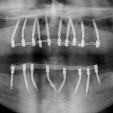 Zubní implantáty 5