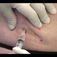 Injekční lipolýza 2