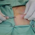 Injekční lipolýza 4