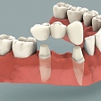Zubní můstek 2