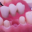 Zubní můstek 3