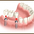 Zubní můstek 4