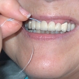 Zubní můstek 5