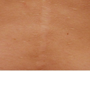 Méně jizev po estetickém zákroku