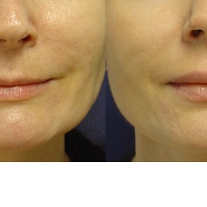 Bioplastika - estetická chirurgie 21. století