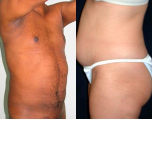 Konec tukových polštářů díky ultrazvukové liposukci Vaser Lipo na klinice Esthé