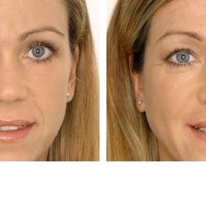 Hity letošního podzimu v metodách nechirurgického zkrášlování pokožky