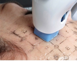 Thermage: Nezestárněte už ani o den