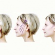 Thread lift – facelifting pomocí nití