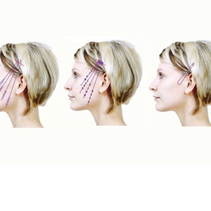 Thread lift – facelifting pomocí nití