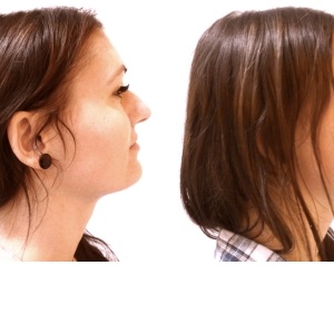 Nový nos mi doslova změnil život