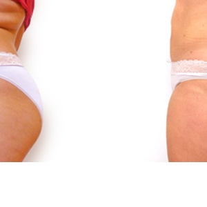 Proměna paní Lady liposukcí VASER Lipo