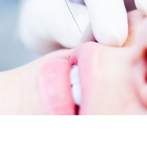 Výplňové implantáty vykouzlí i nový nos