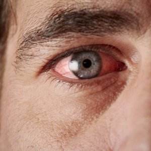 Tipy, které vás zbaví zarudlých očí