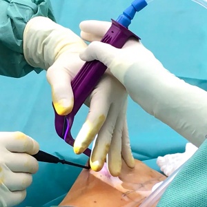 Minimální jizva, přirozený tvar a doživotní záruka – to jsou silikonové implantáty Motiva