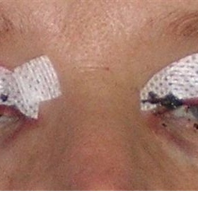 Fotogalerie - průběh hojení po operaci horních víček