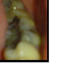 Druhy výplní zubů (rozdíly,výhody)