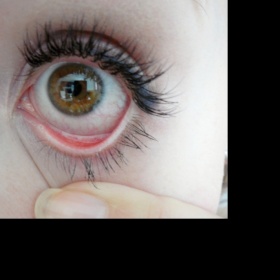 Otok a červené žilky v oku po prodloužení řas