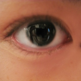 Odstranění vystouplého znaménka u oka