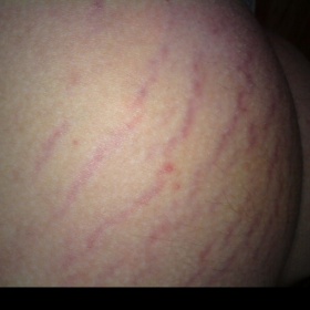 Ćervená vyrážka na zadku a stehnech