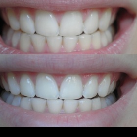 Hodnocení bělení metodou Opalescence