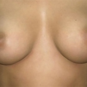 Augmentace prsou 70C - jaký bude výsledek?