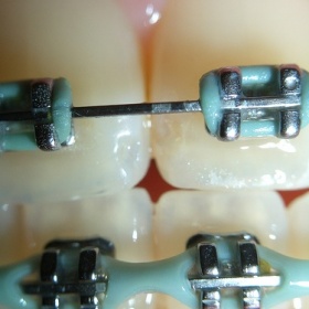 Rozdíly mezi rovnátky