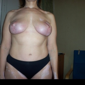 Pichanie  v prsníku po 3 mesiacoch od opky (zmenšenie)