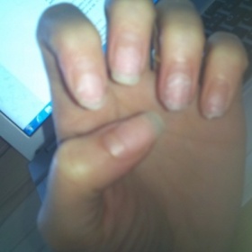 Ozdravení nehtů po odstranění akrylových nehtů