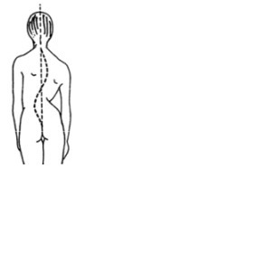 Esovitá skolióza - co dělat aby záda nebolela