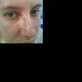 Promáčklina na nose po masáži