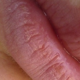 Léčebný přípravek na rozpraskané rty