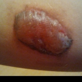 Znaménko po třetí laserové operaci napuchlo