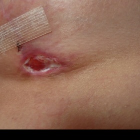 Rána v podprsní rýze po modelaci prsou