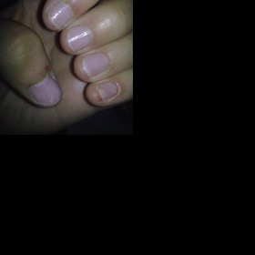 Puchýřky okolo nehtů na rukou