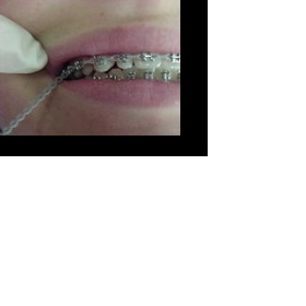 Čištění překřížených gumiček do rovnátek