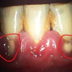 Onemocnění dásní, zubů