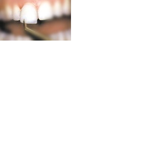 Adhezivní keramické fazety