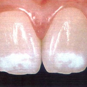 Bílé skvrny na zubech - můžu bělit?